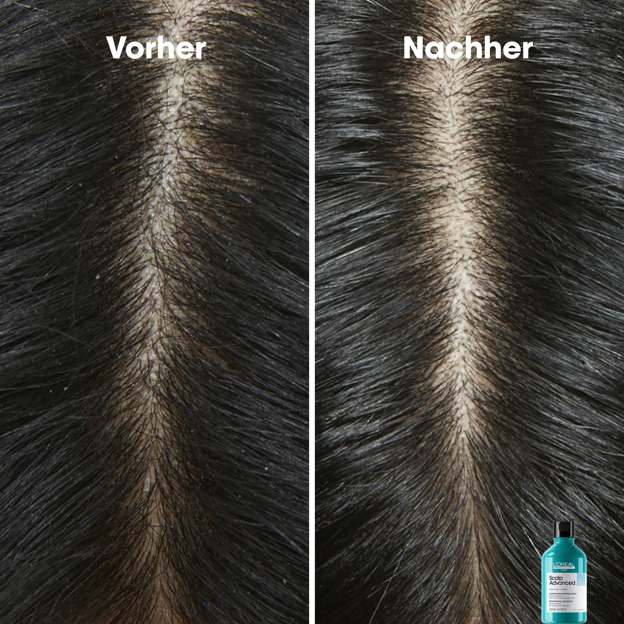 L'Oreal SE Sca A-Dndrf Shp 300 VB98